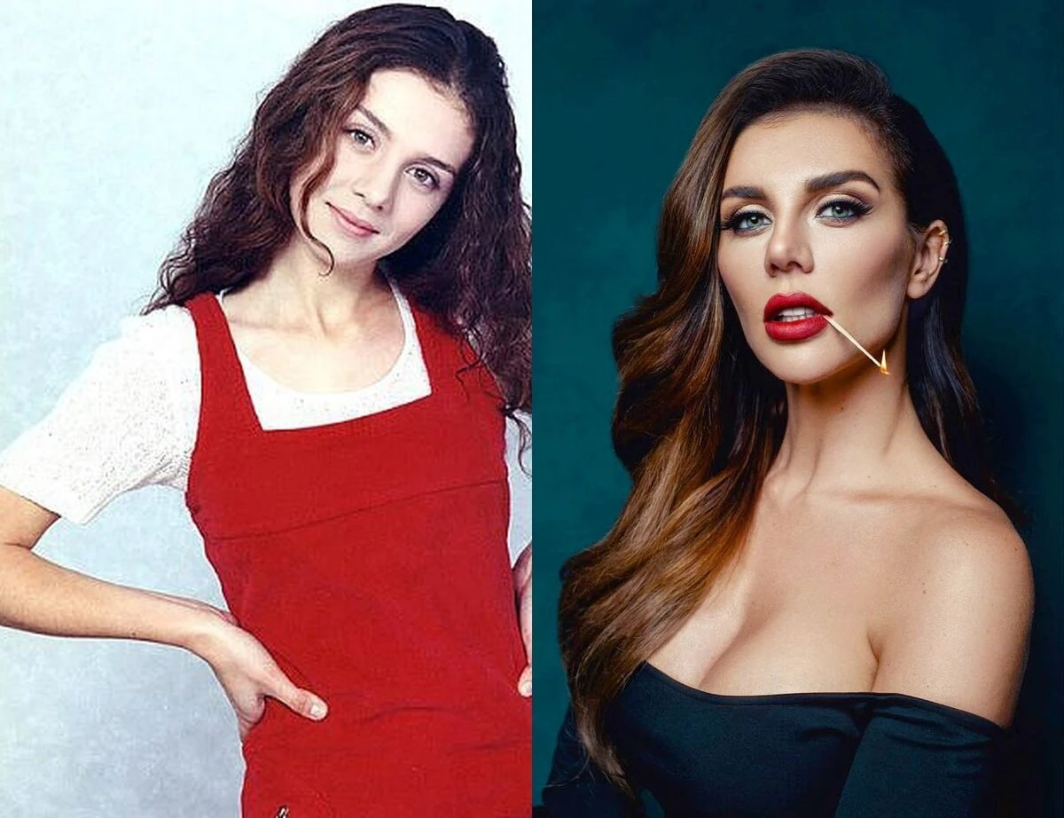 sedokova-plastyka-preobrazhennya-anny-sedokovoyi-4cb4